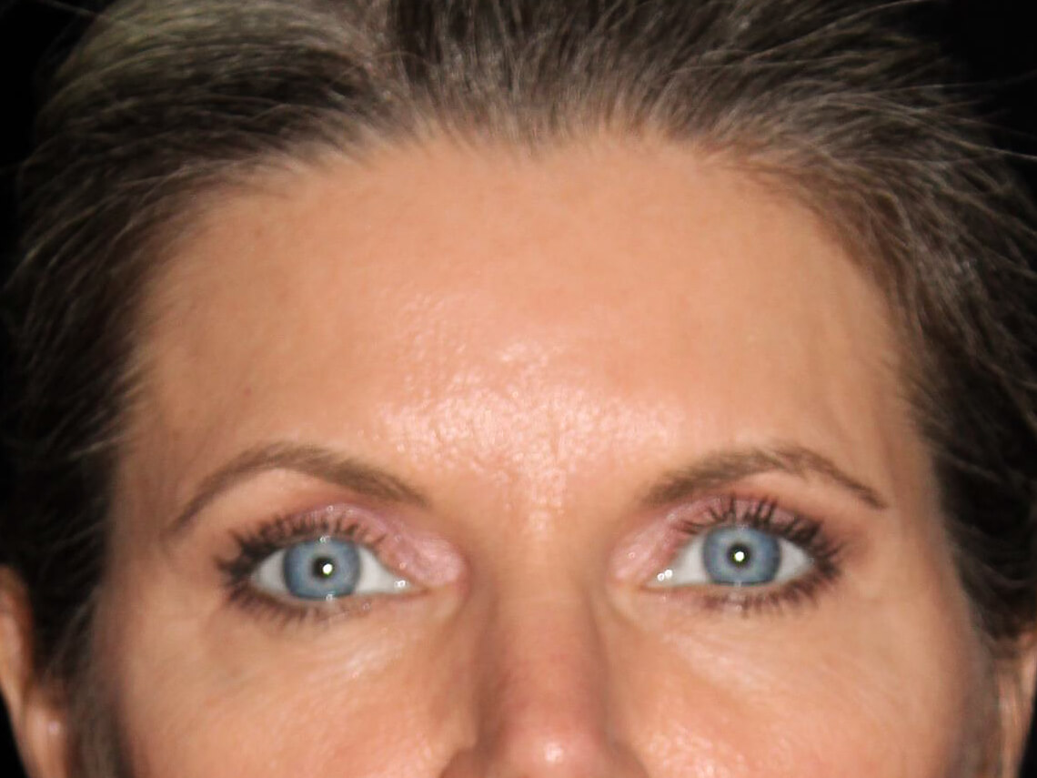 Eyelid Surgery Patient Photo - Case 6954 - after view-1