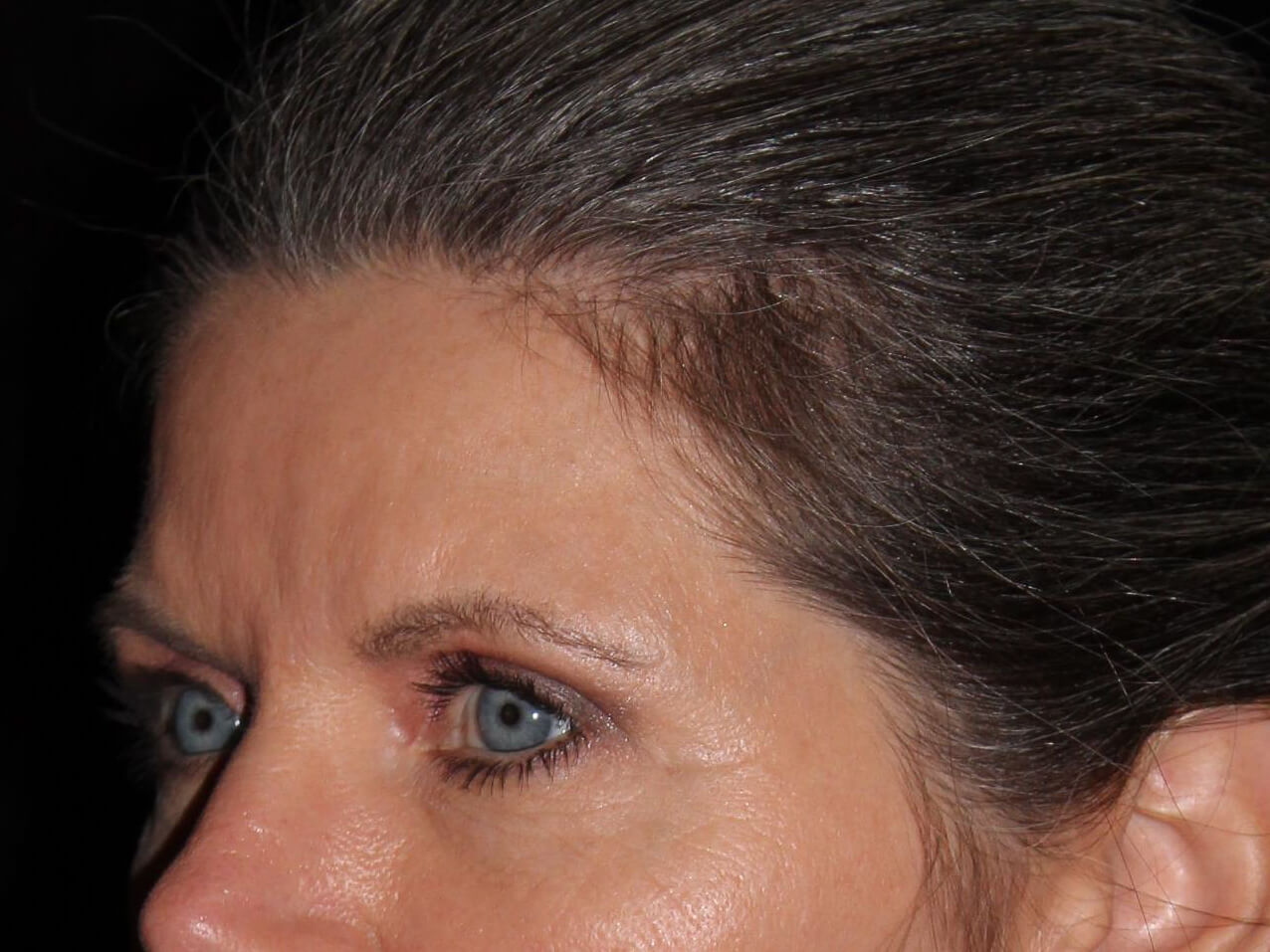 Eyelid Surgery Patient Photo - Case 6954 - after view-2