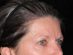 Eyelid Surgery - Case 6954 - Before
