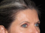 Eyelid Surgery - Case 6954 - After