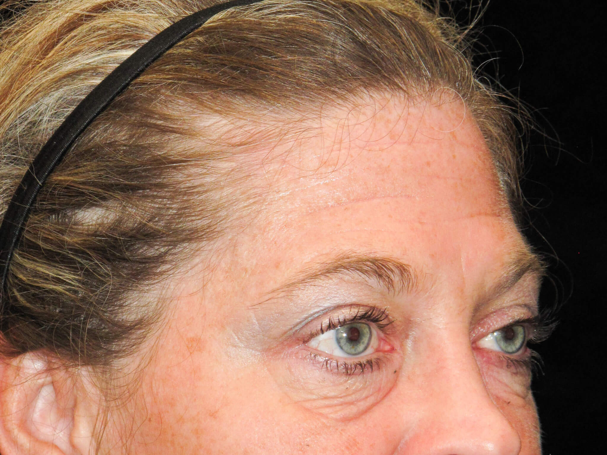 Eyelid Surgery Patient Photo - Case 10448 - before view-1