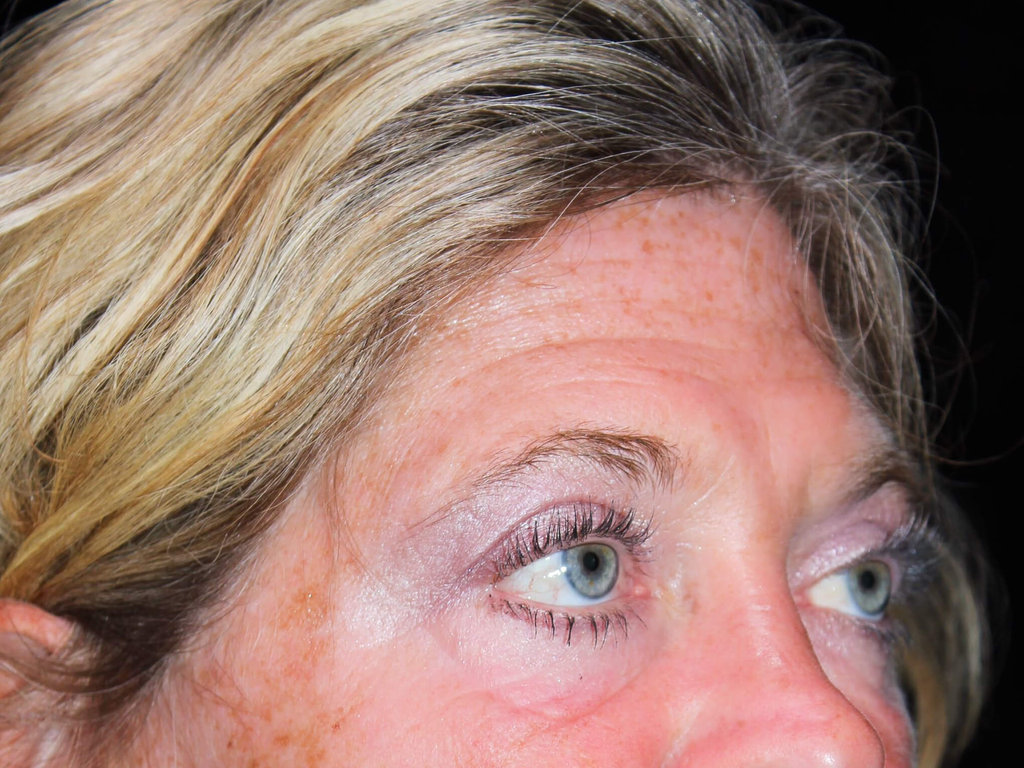 Eyelid Surgery Patient Photo - Case 10448 - after view-1