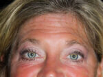 Eyelid Surgery - Case 10448 - After