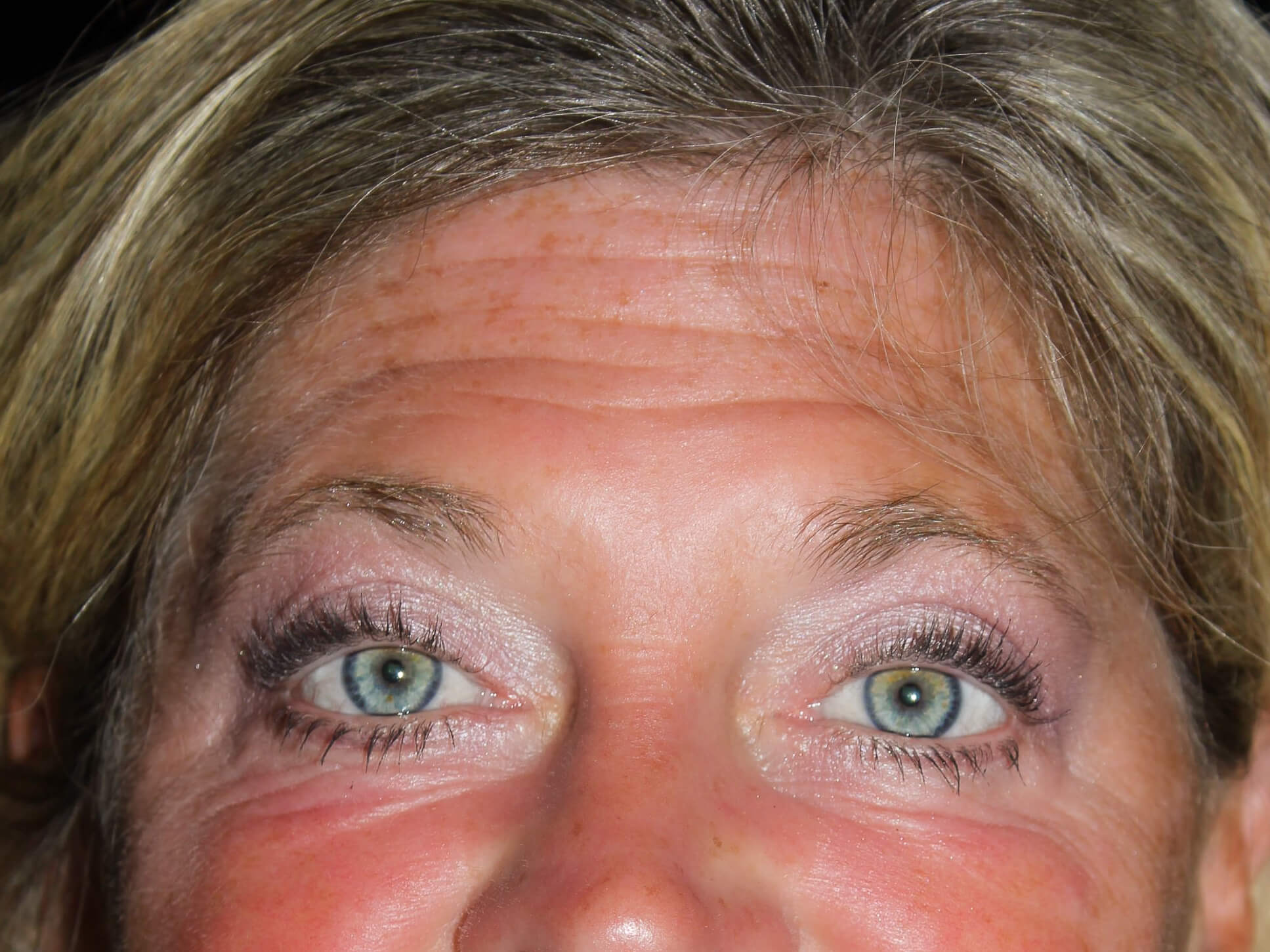 Eyelid Surgery Patient Photo - Case 10448 - after view