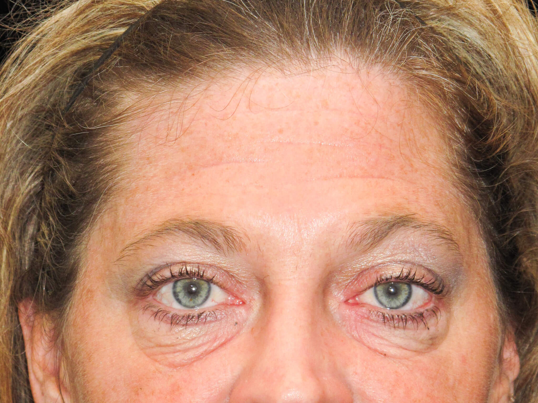 Eyelid Surgery Patient Photo - Case 10448 - before view-