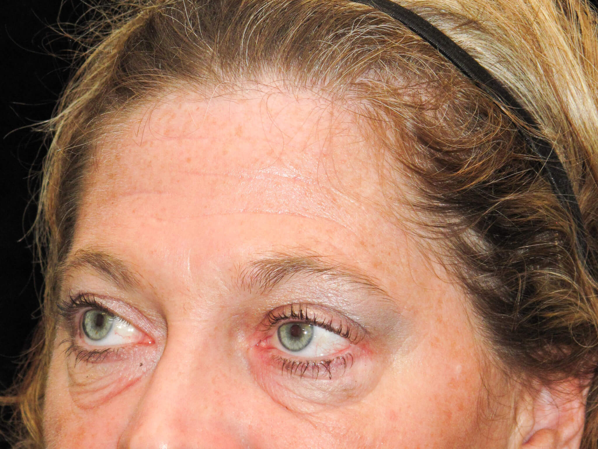 Eyelid Surgery Patient Photo - Case 10448 - before view-2