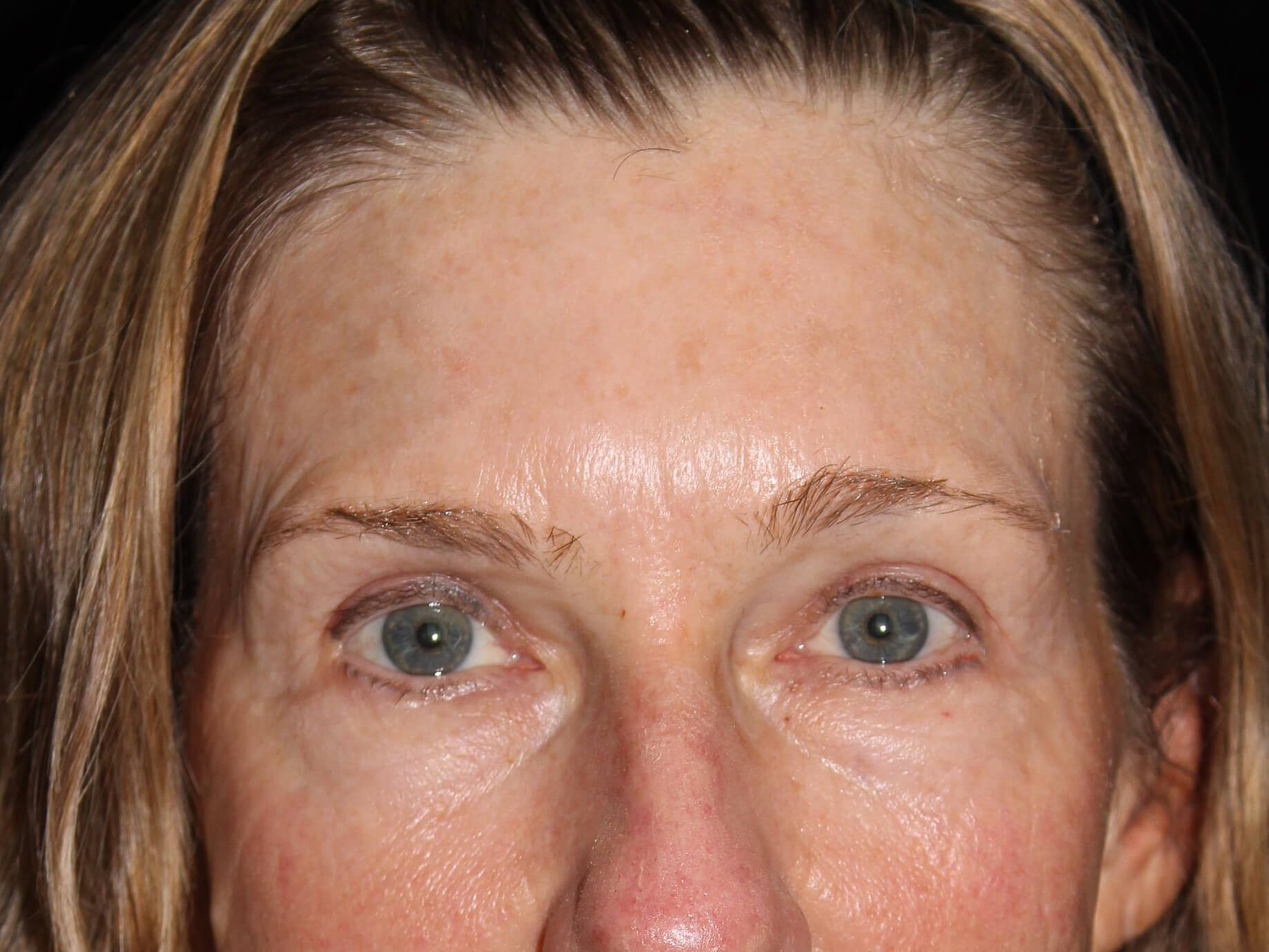 Eyelid Surgery Patient Photo - Case 10461 - after view