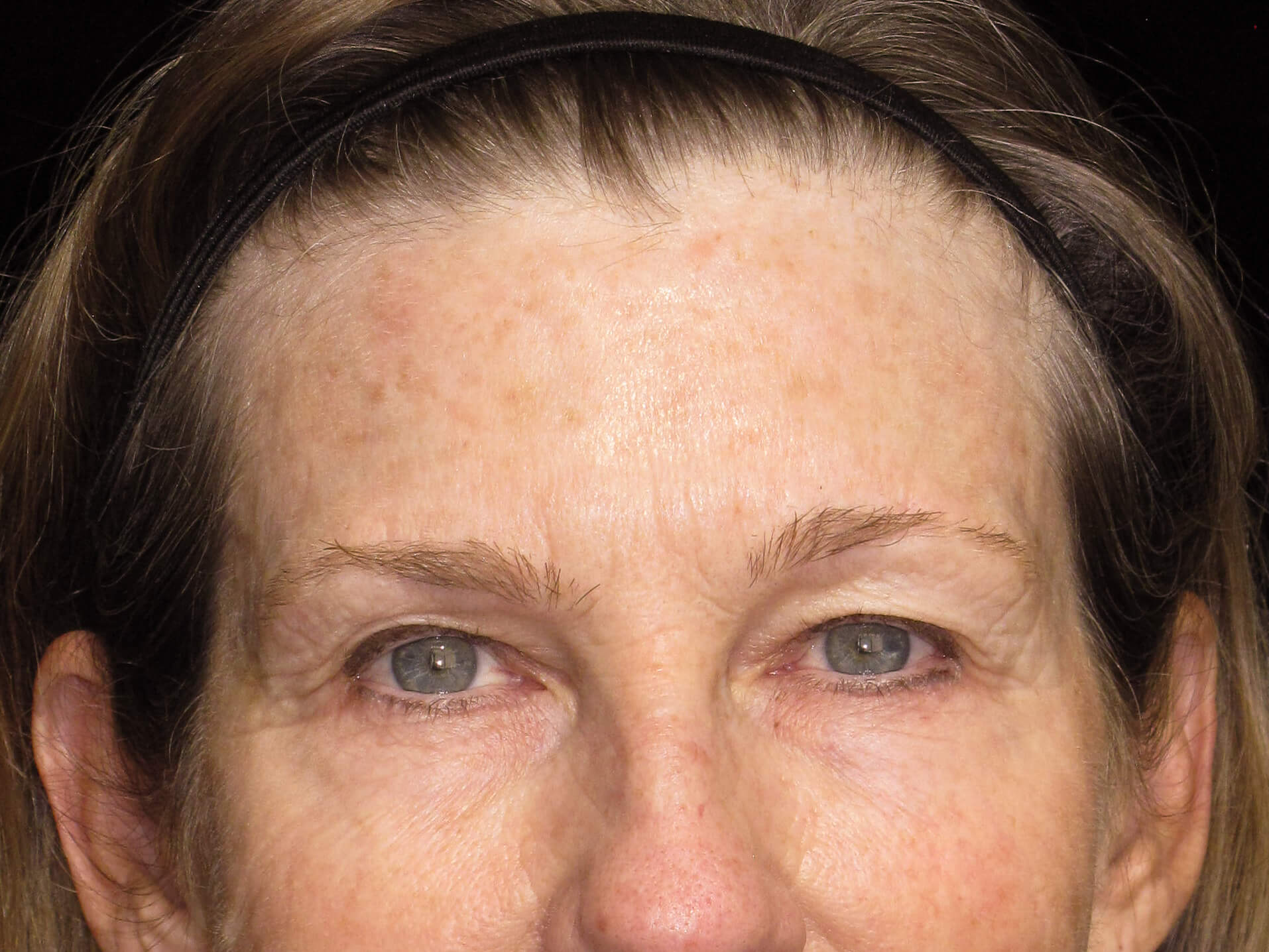 Eyelid Surgery Patient Photo - Case 10461 - before view-