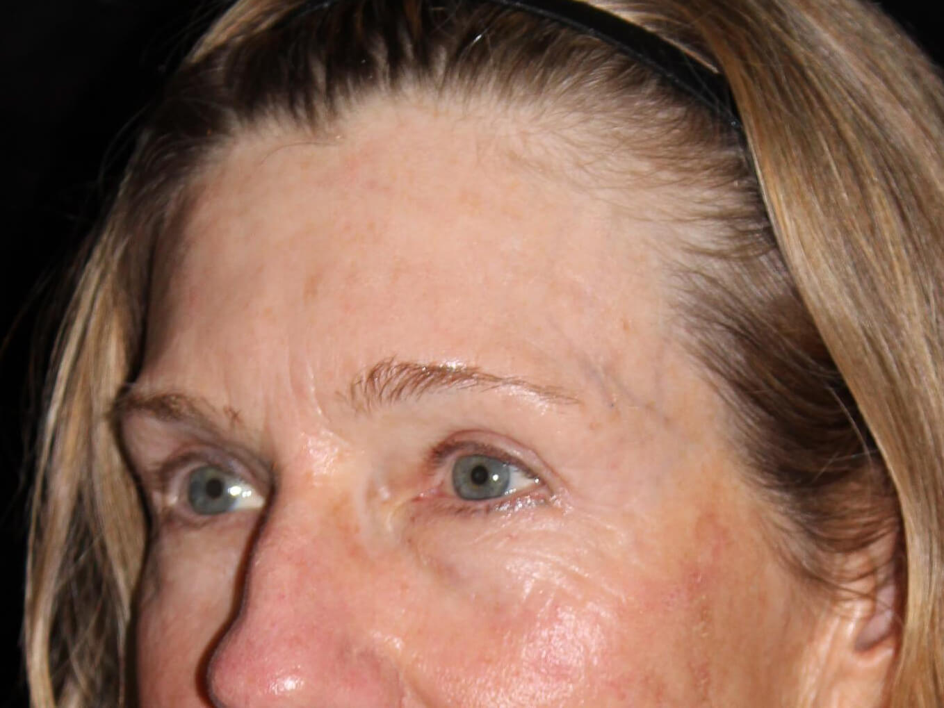 Eyelid Surgery Patient Photo - Case 10461 - after view-2