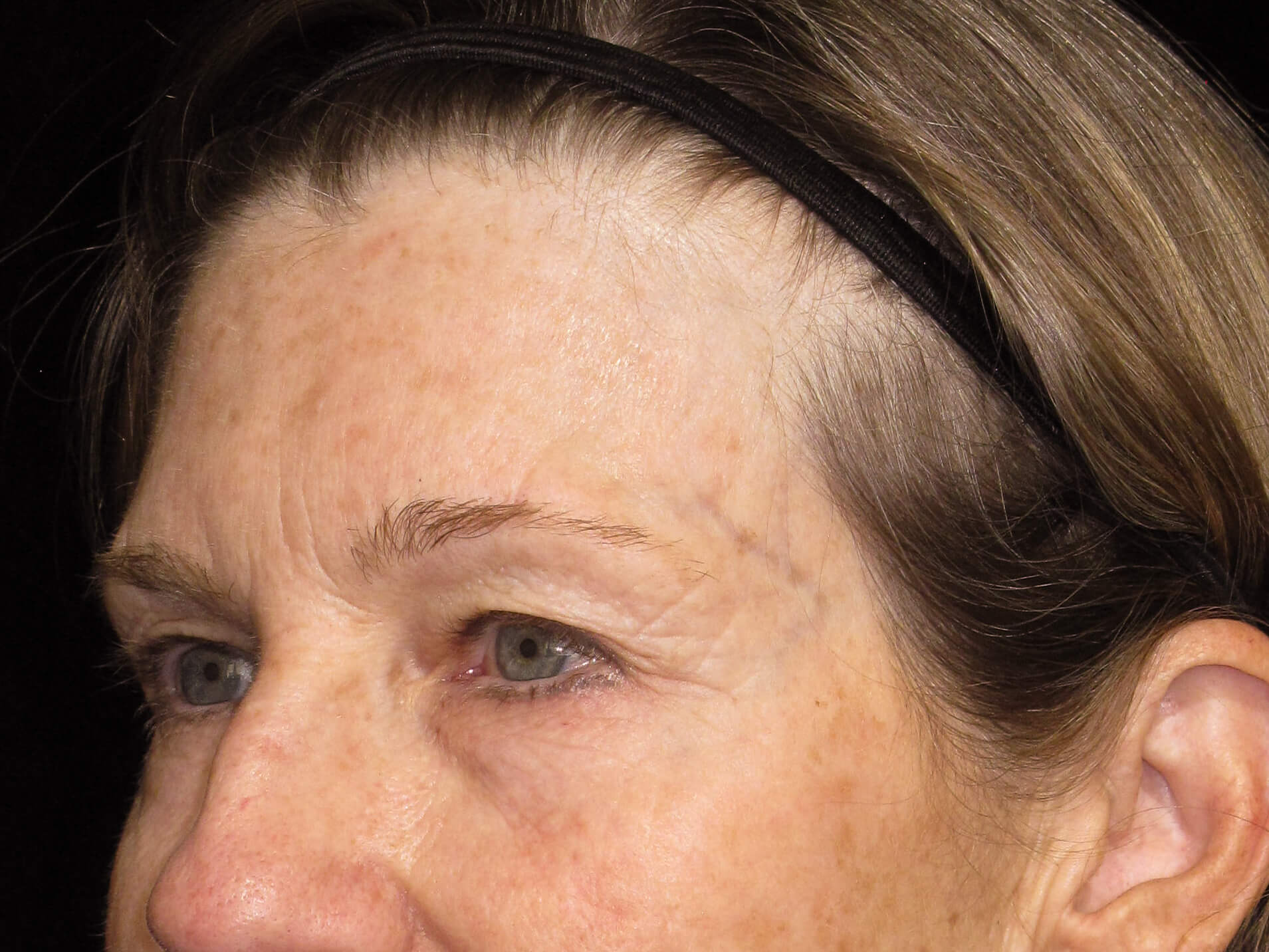 Eyelid Surgery Patient Photo - Case 10461 - before view-2