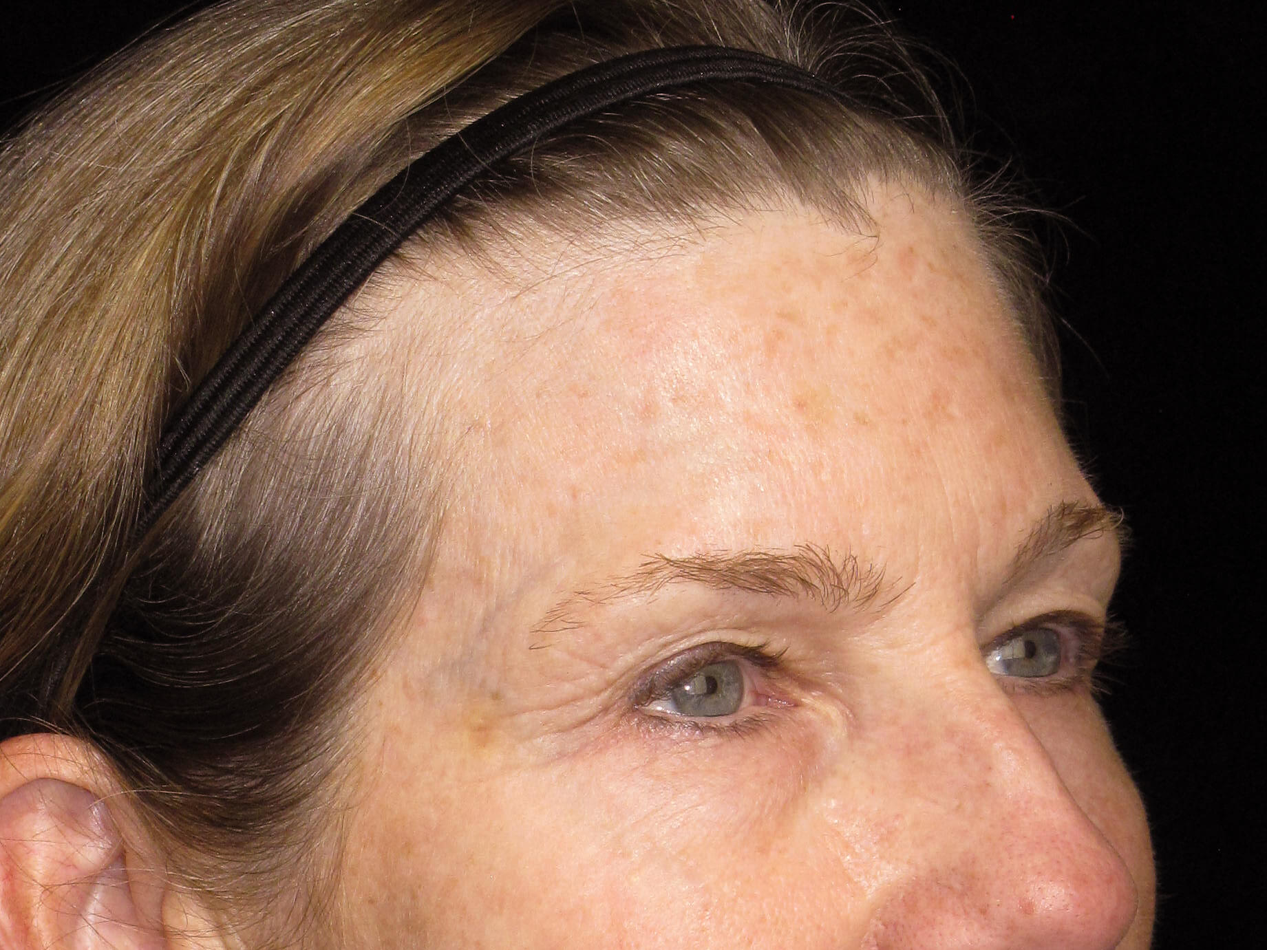 Eyelid Surgery Patient Photo - Case 10461 - before view-1