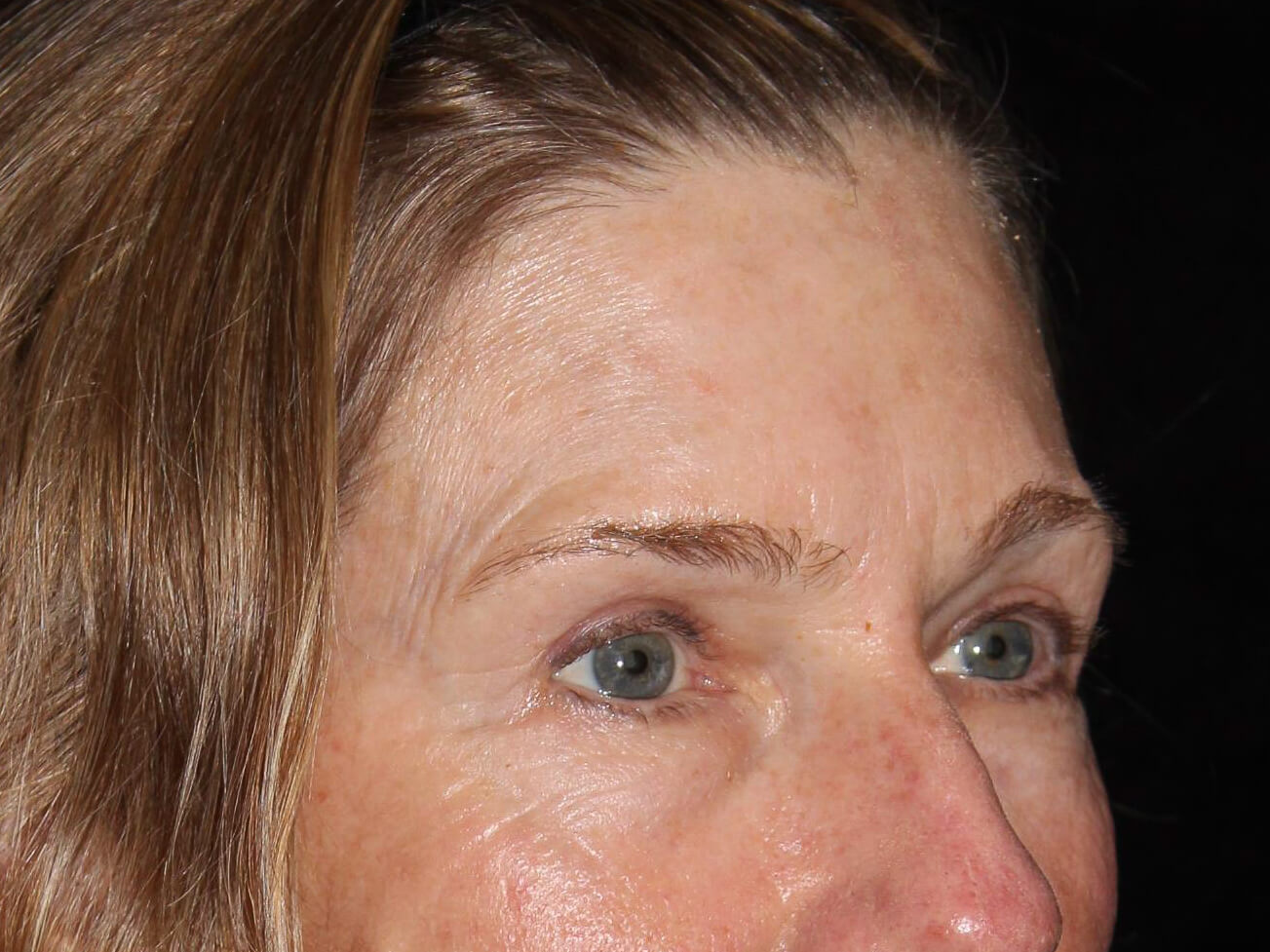 Eyelid Surgery Patient Photo - Case 10461 - after view-1