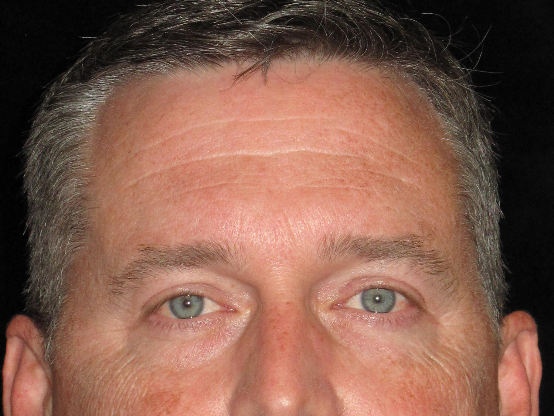 Eyelid Surgery before and after results - Nashville patient - after