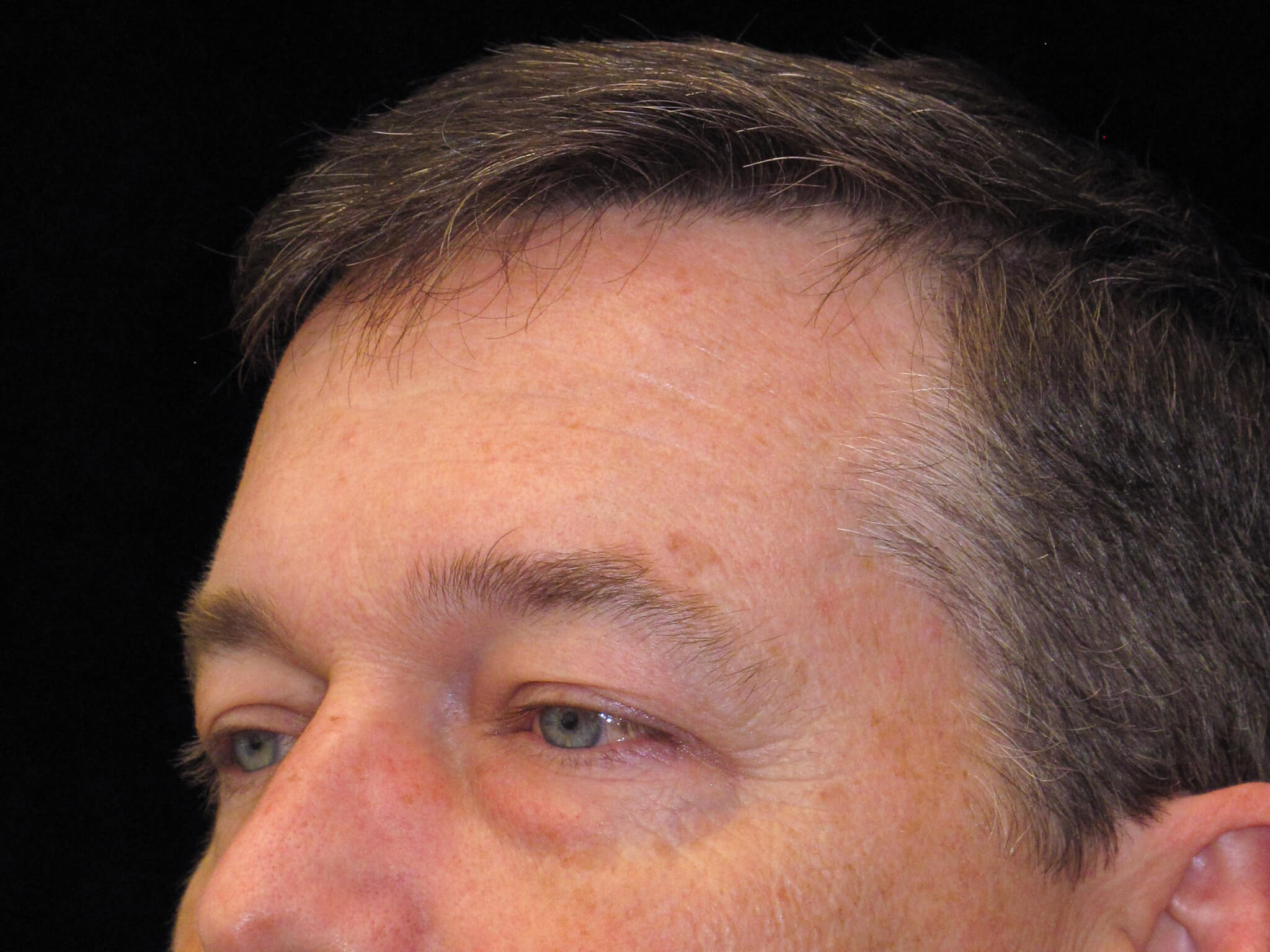 Eyelid Surgery before and after results - Nashville patient - before view 3