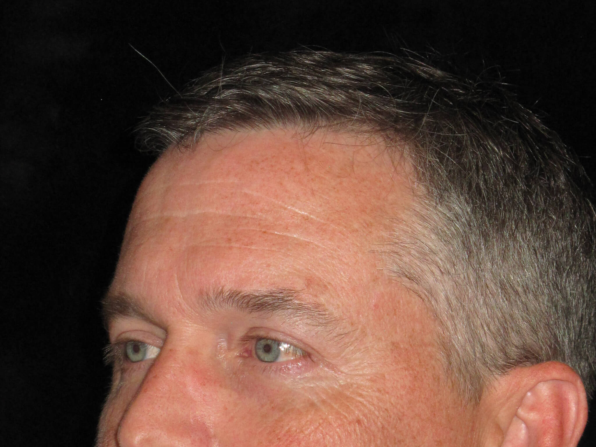 Eyelid Surgery before and after results - Nashville patient - after view 3