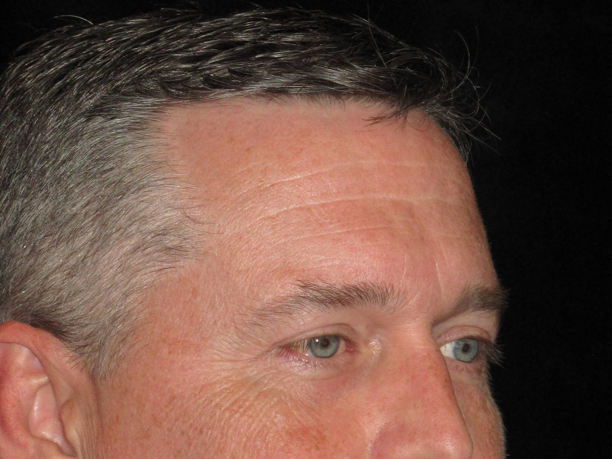 Eyelid Surgery before and after results - Nashville patient - after view 2