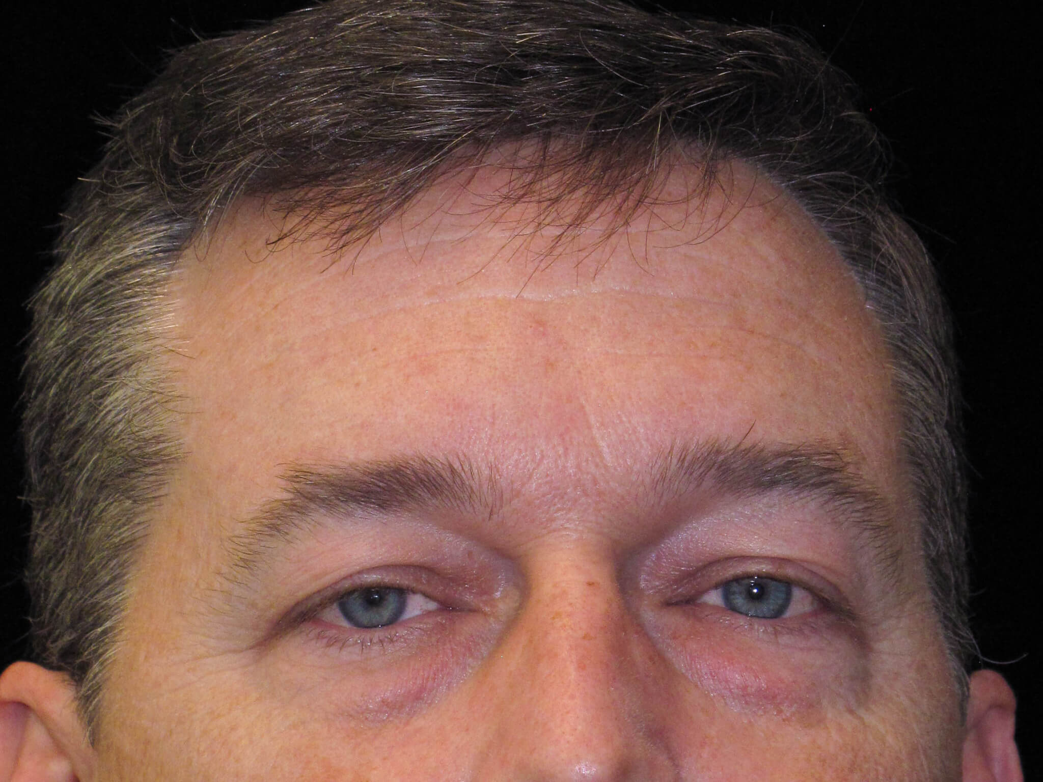 Eyelid Surgery before and after results - Nashville patient - before