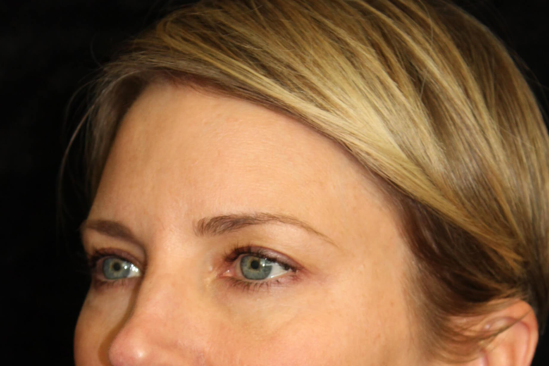 Eyelid Surgery before and after results - Nashville patient - after view 2