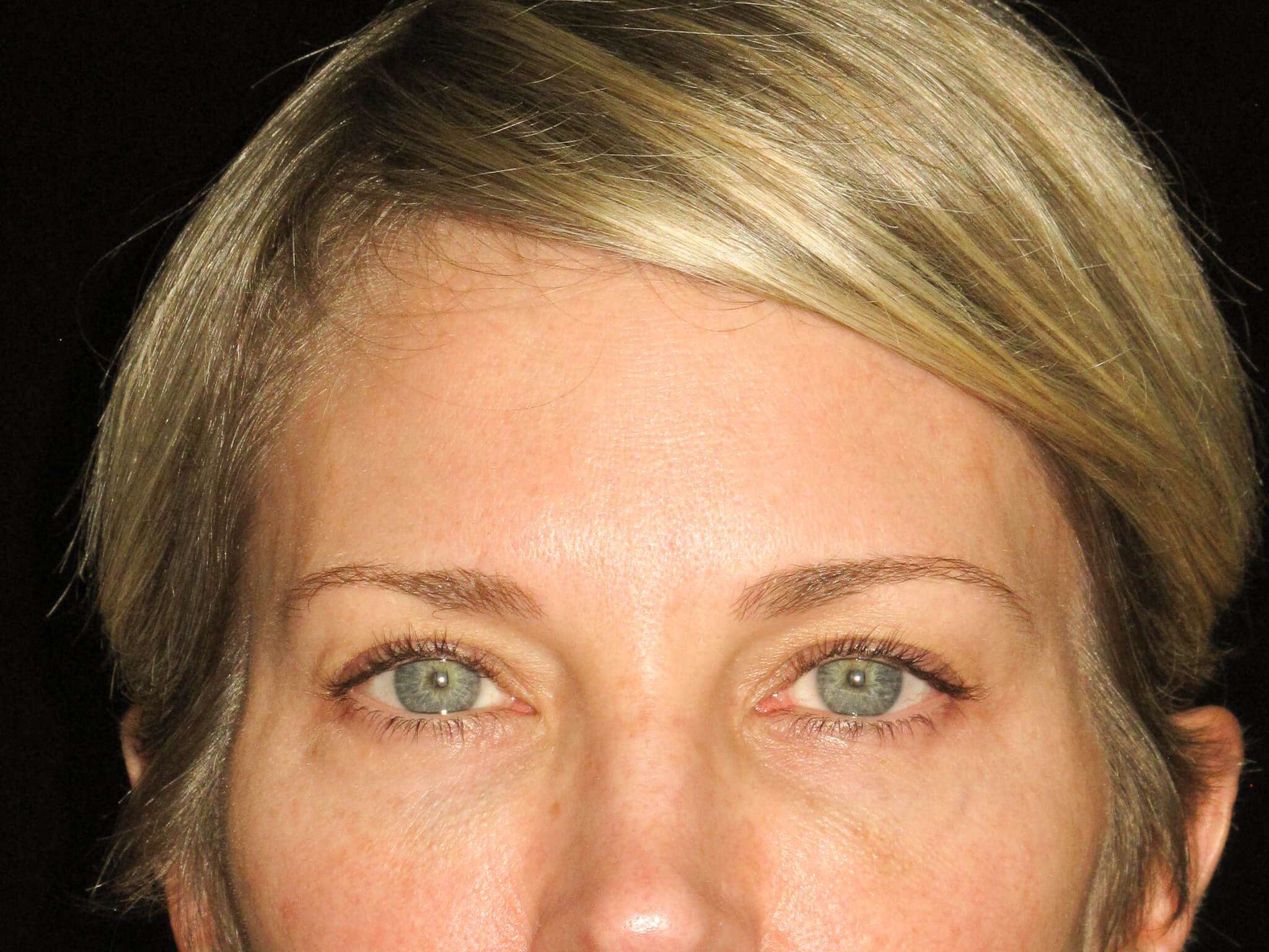 Eyelid Surgery before and after results - Nashville patient - before