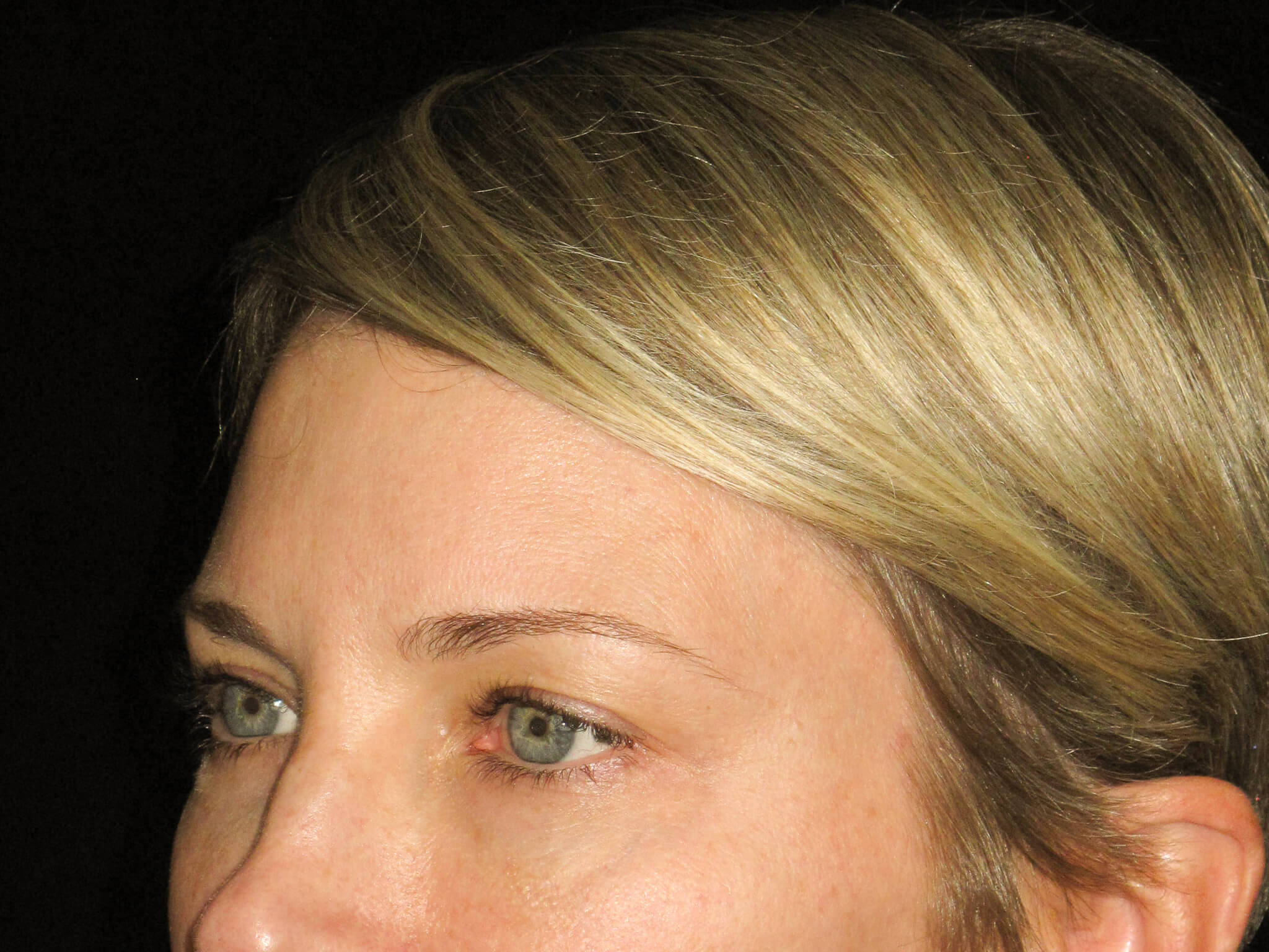 Eyelid Surgery before and after results - Nashville patient - before view 2