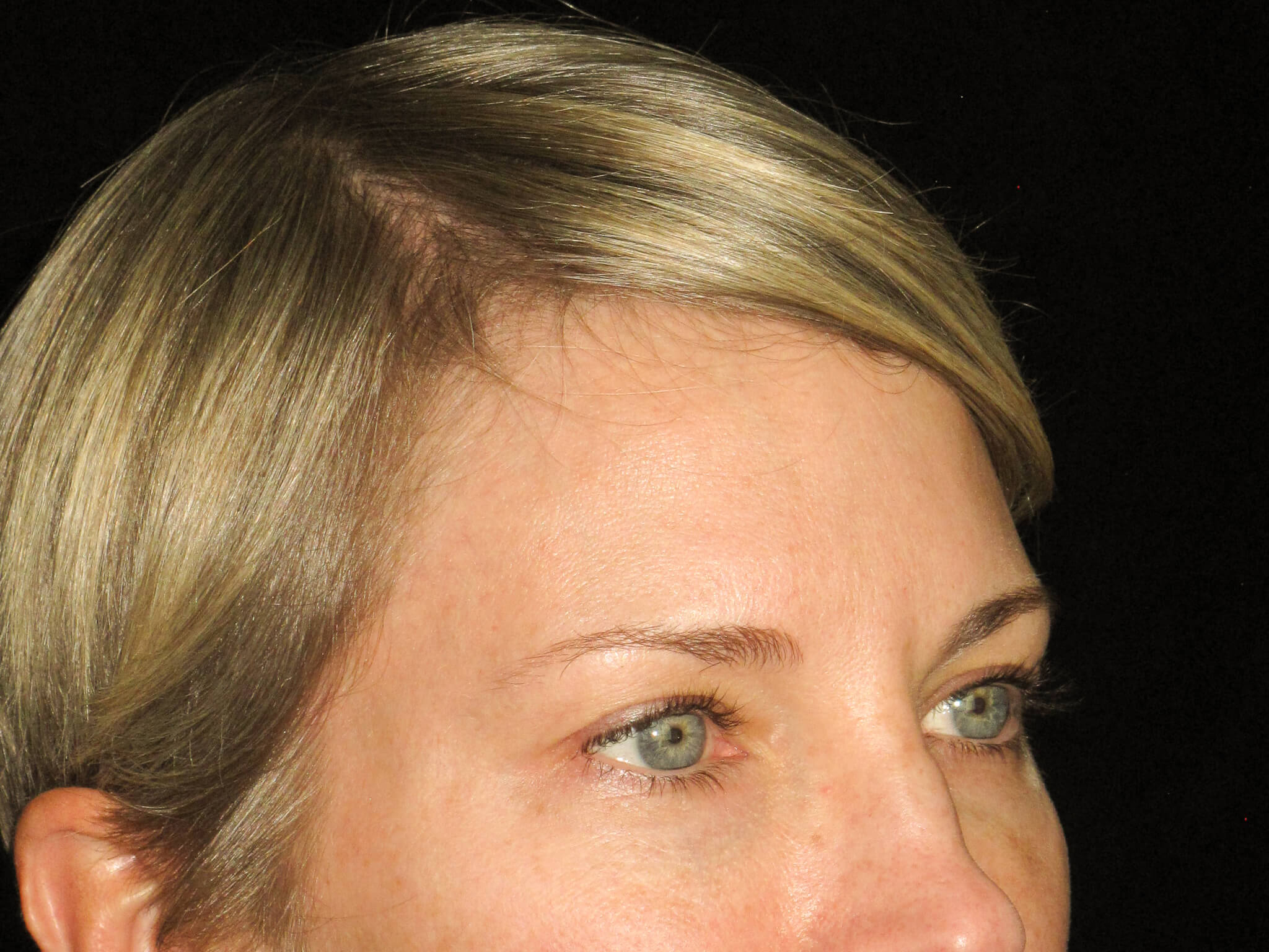 Eyelid Surgery before and after results - Nashville patient - before view 3