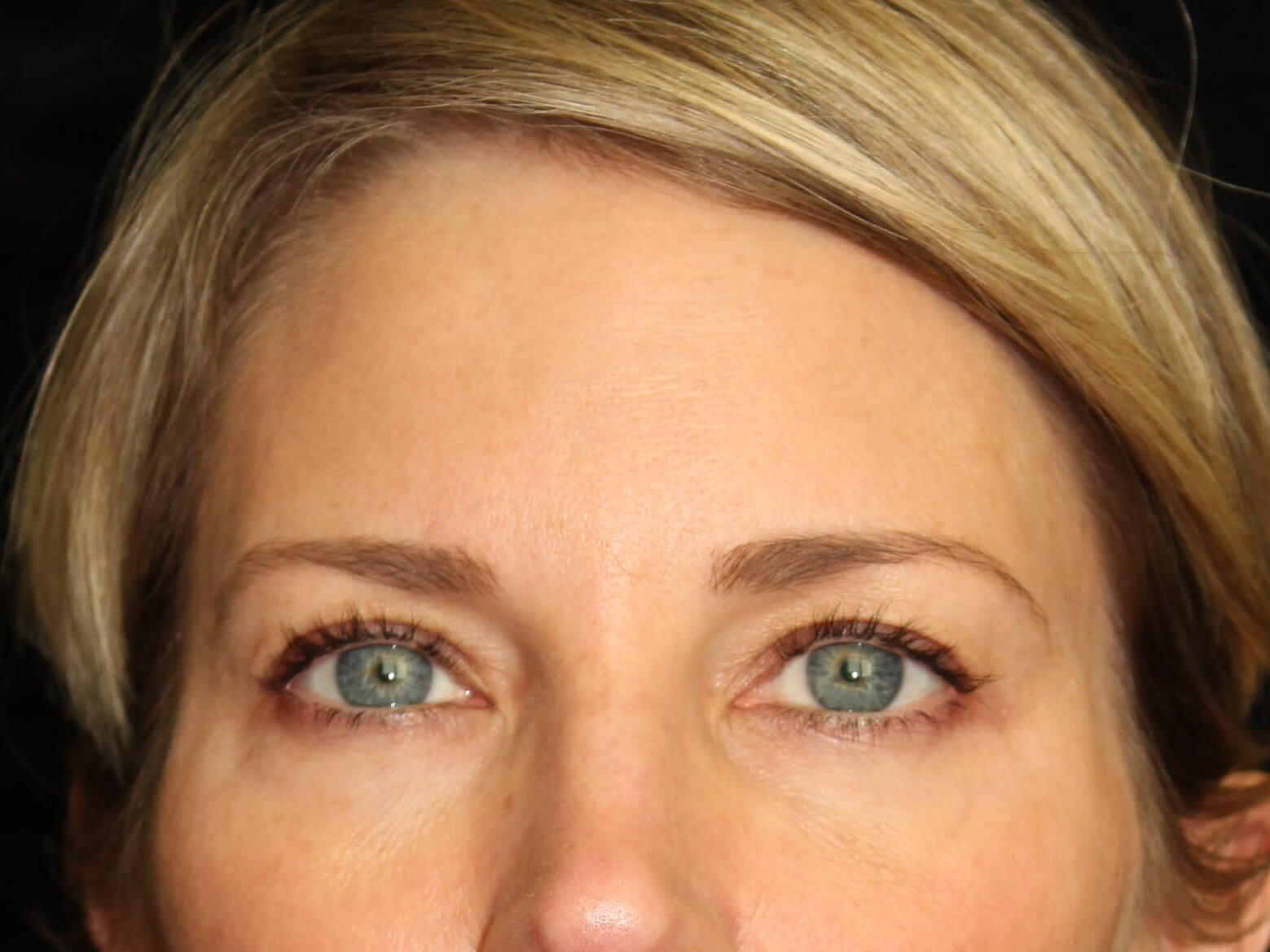 Eyelid Surgery before and after results - Nashville patient - after