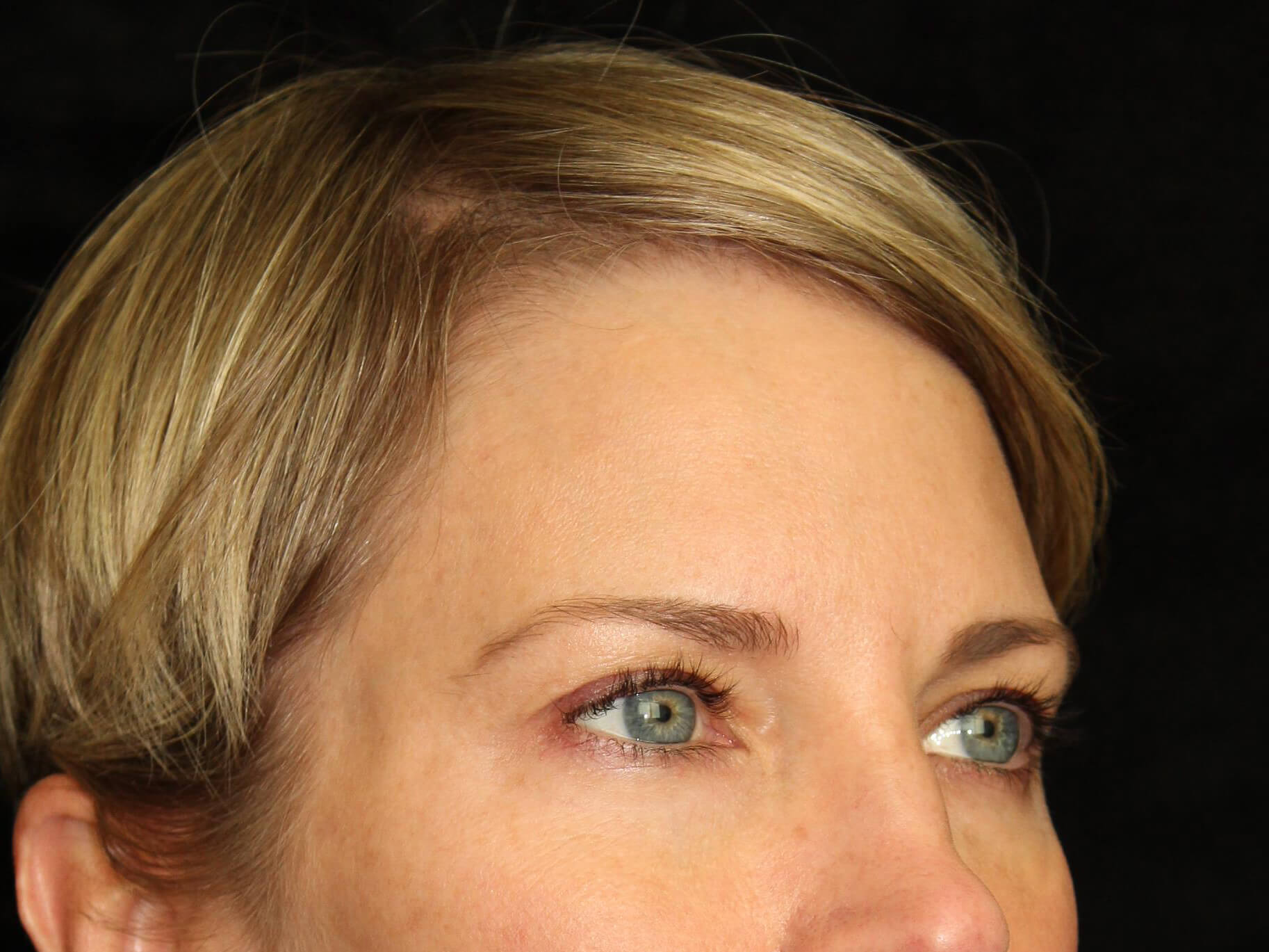 Eyelid Surgery before and after results - Nashville patient - after view 3