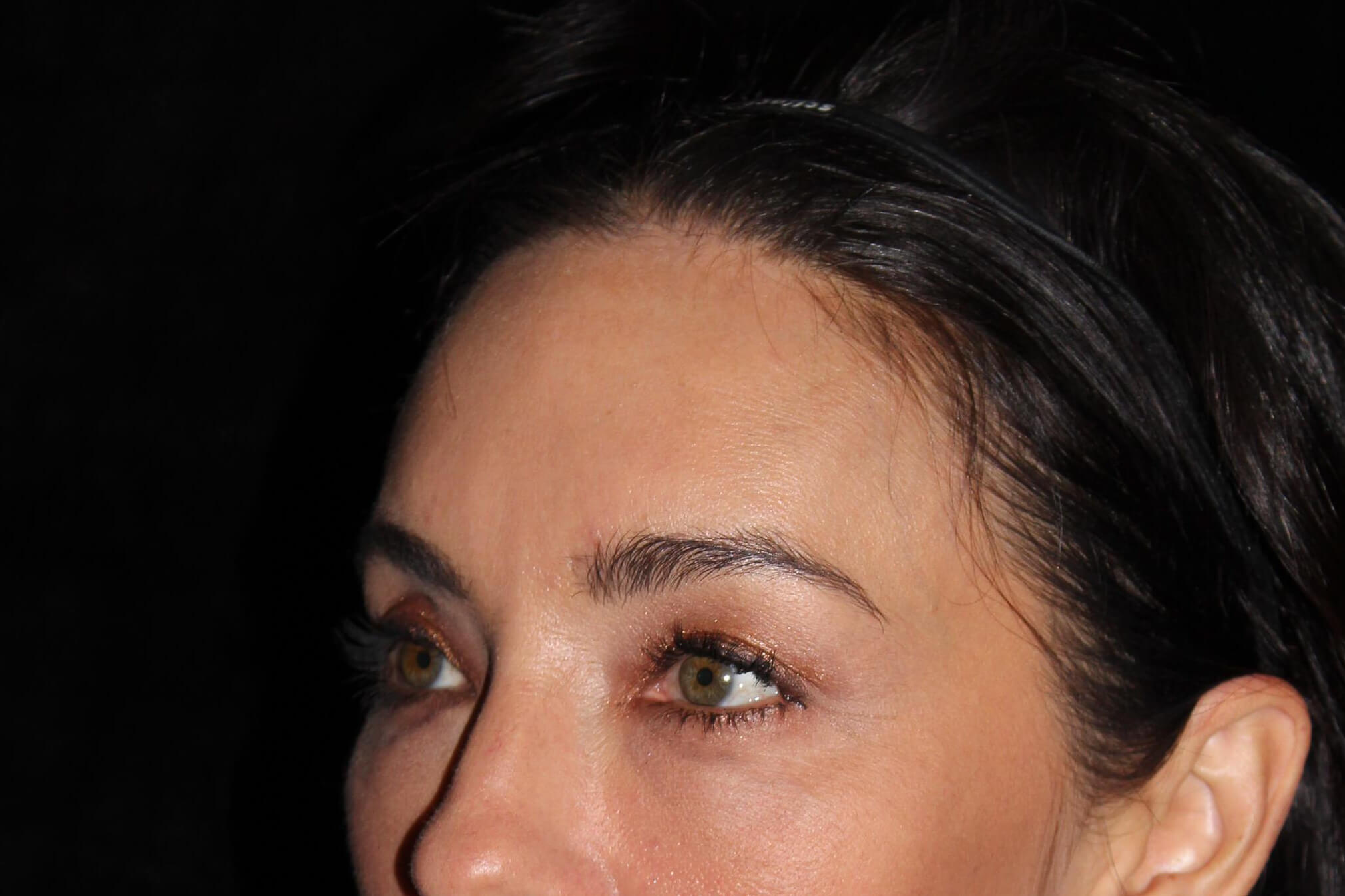 Eyelid Surgery before and after results - Nashville patient - after view 3