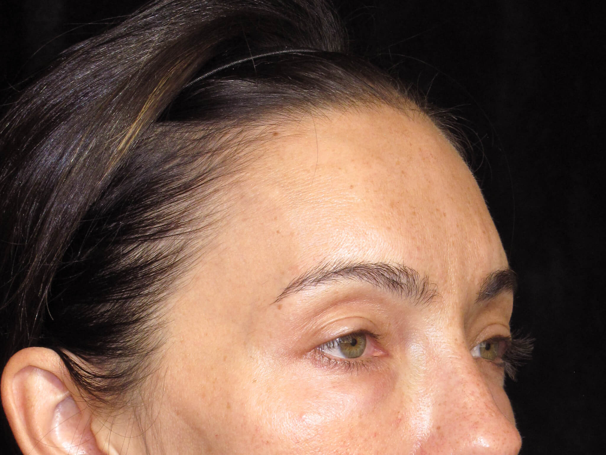 Eyelid Surgery before and after results - Nashville patient - before view 2