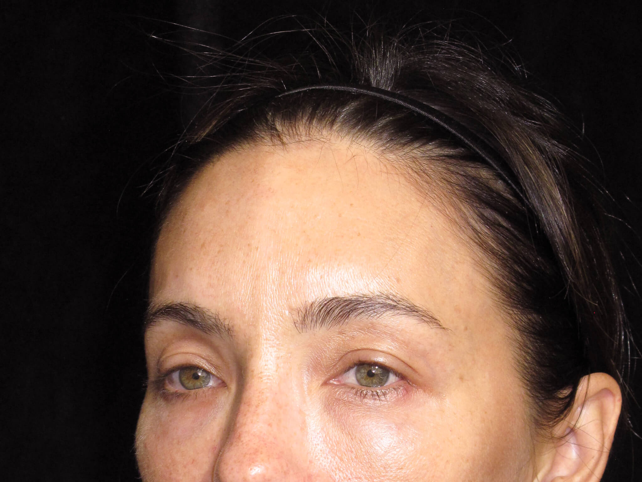 Eyelid Surgery before and after results - Nashville patient - before view 3