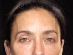 Eyelid Surgery - Case 6636 - Before