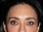 Eyelid Surgery - Case 6636 - After