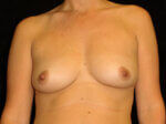 Breast Asymmetry - Case 14902 - Before