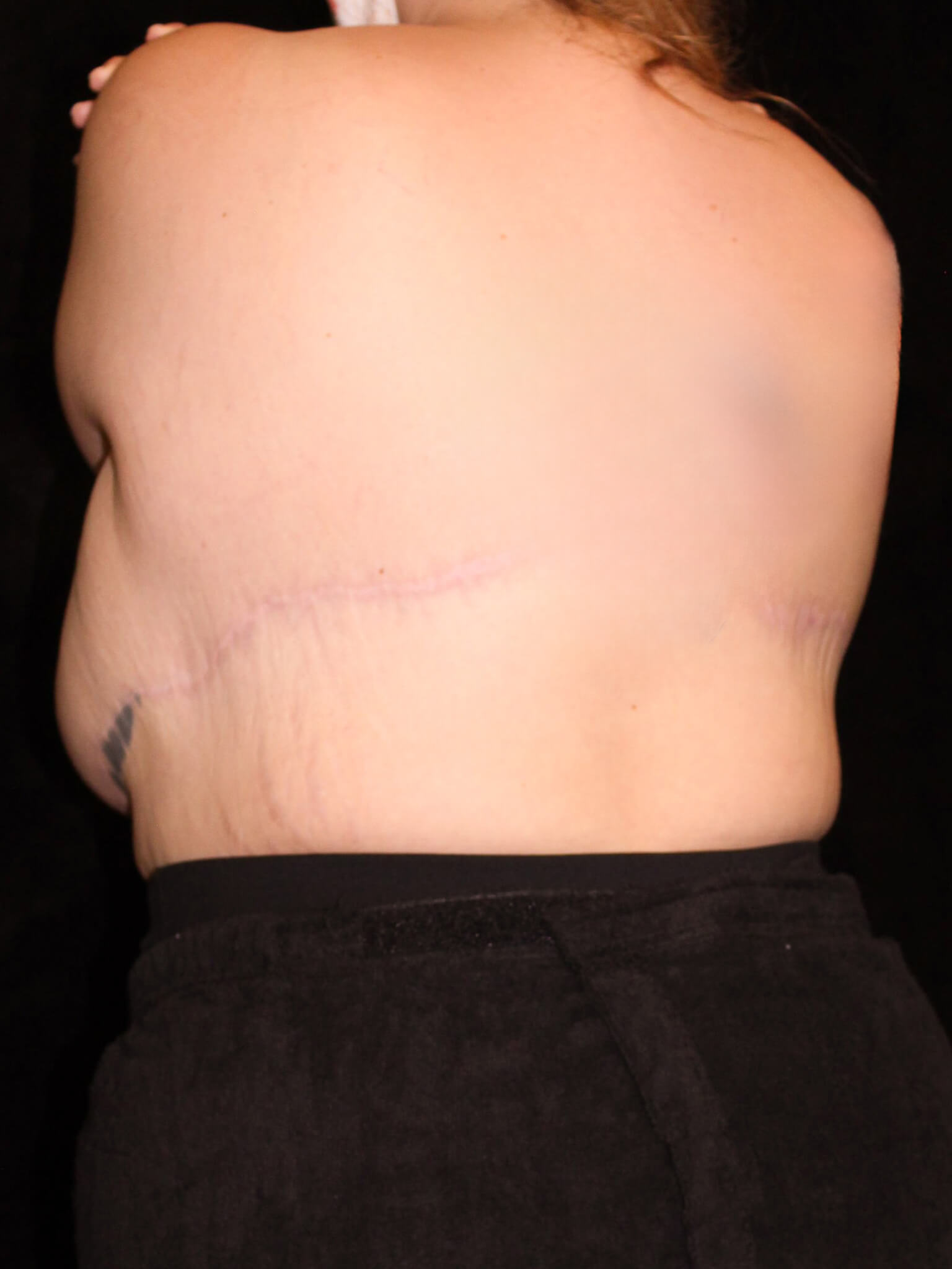 Body Lift Patient Photo - Case 15848 - after view-3