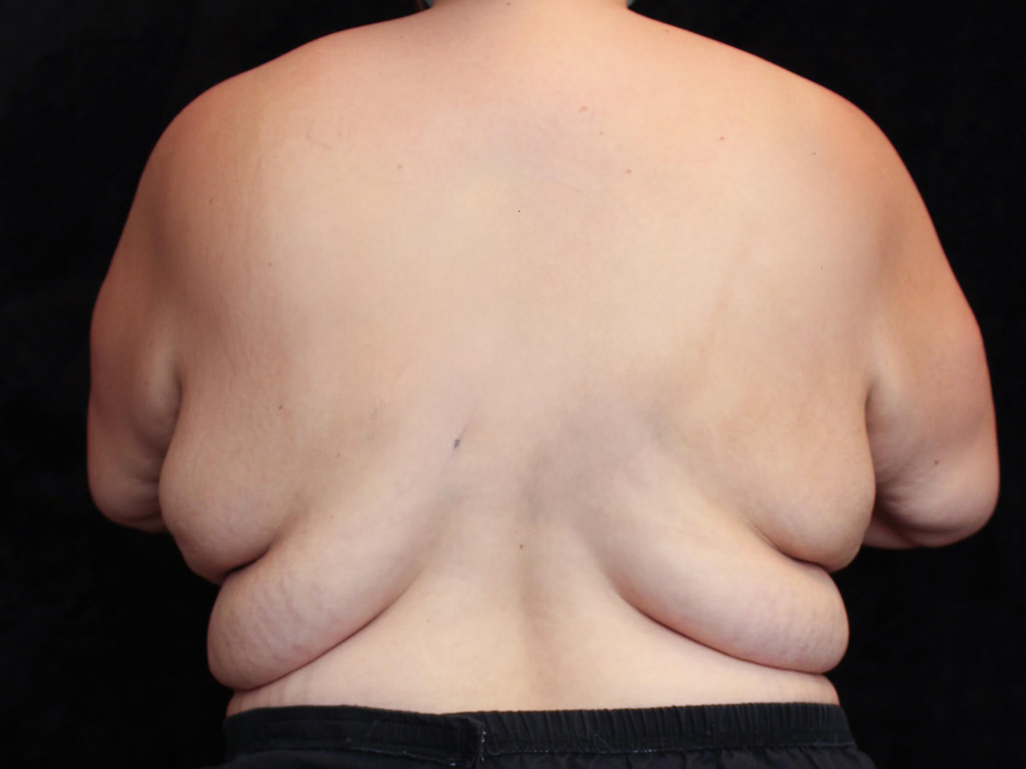 Body Lift Patient Photo - Case 15848 - before view-4