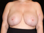 Body Lift - Case 15848 - After