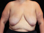 Body Lift - Case 15848 - Before