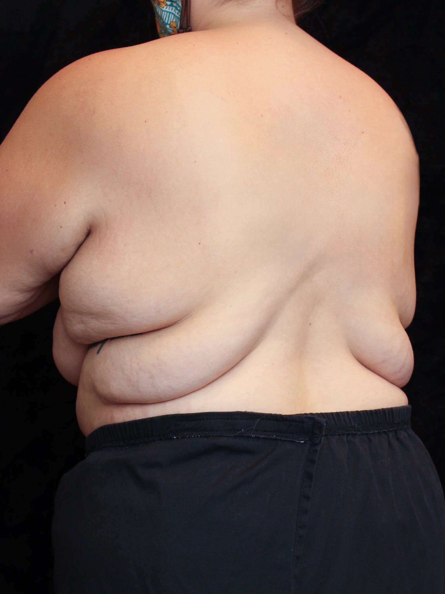 Body Lift Patient Photo - Case 15848 - before view-3