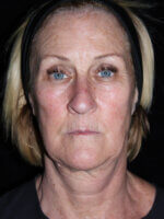 Facelift - Case 16461 - Before