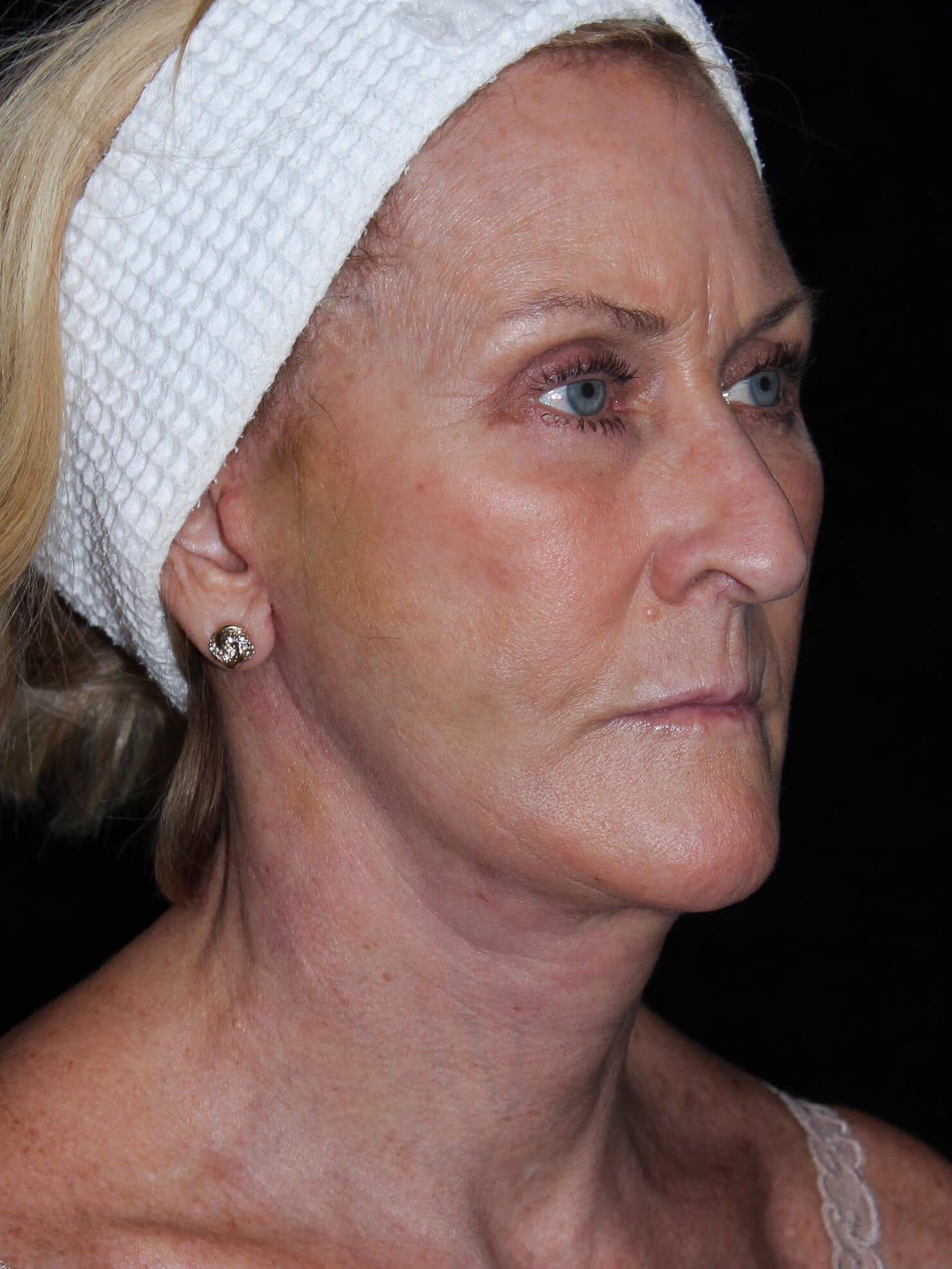 Facelift Patient Photo - Case 16461 - after view-1
