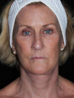 Facelift - Case 16461 - After