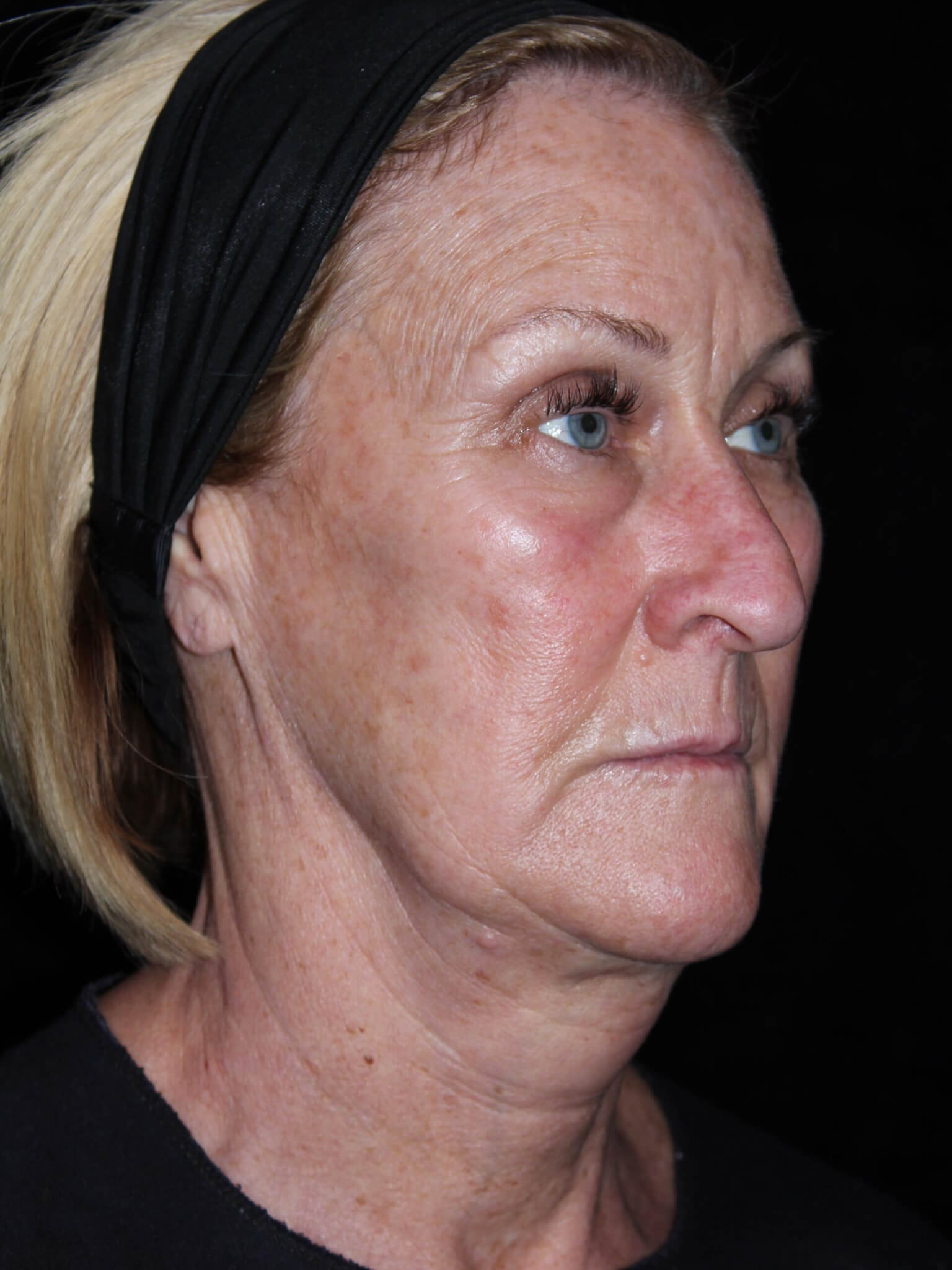 Facelift Patient Photo - Case 16461 - before view-1
