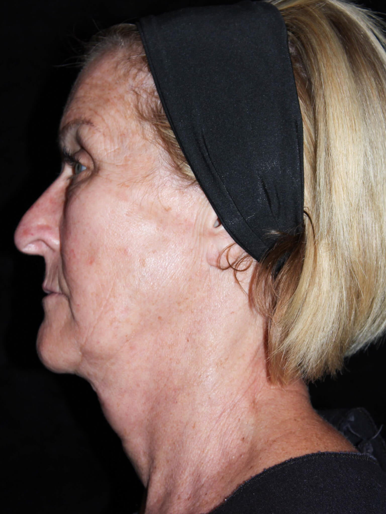 Facelift Patient Photo - Case 16461 - before view-2