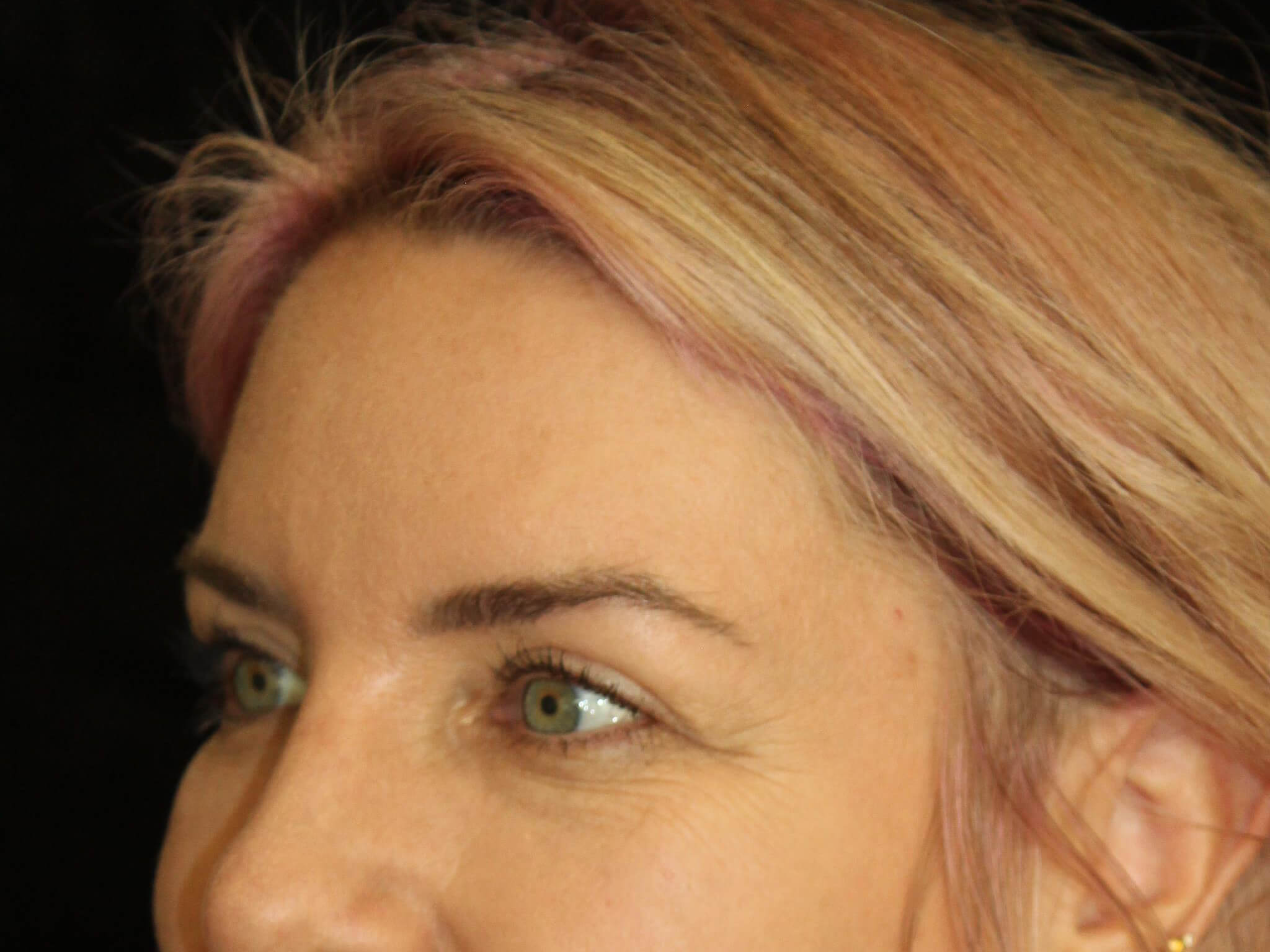 Eyelid Surgery Patient Photo - Case 18654 - after view-2