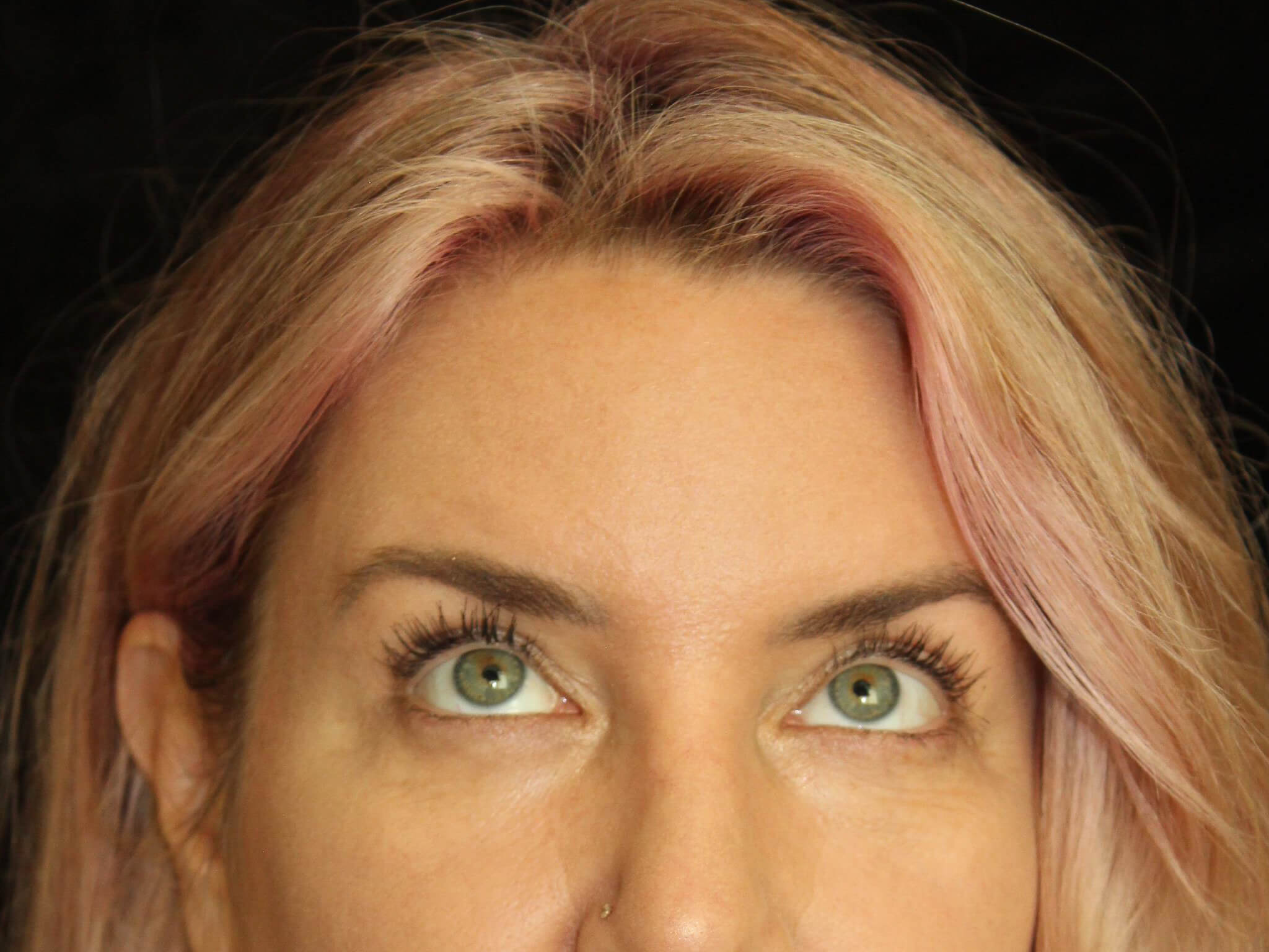 Eyelid Surgery Patient Photo - Case 18654 - after view-1