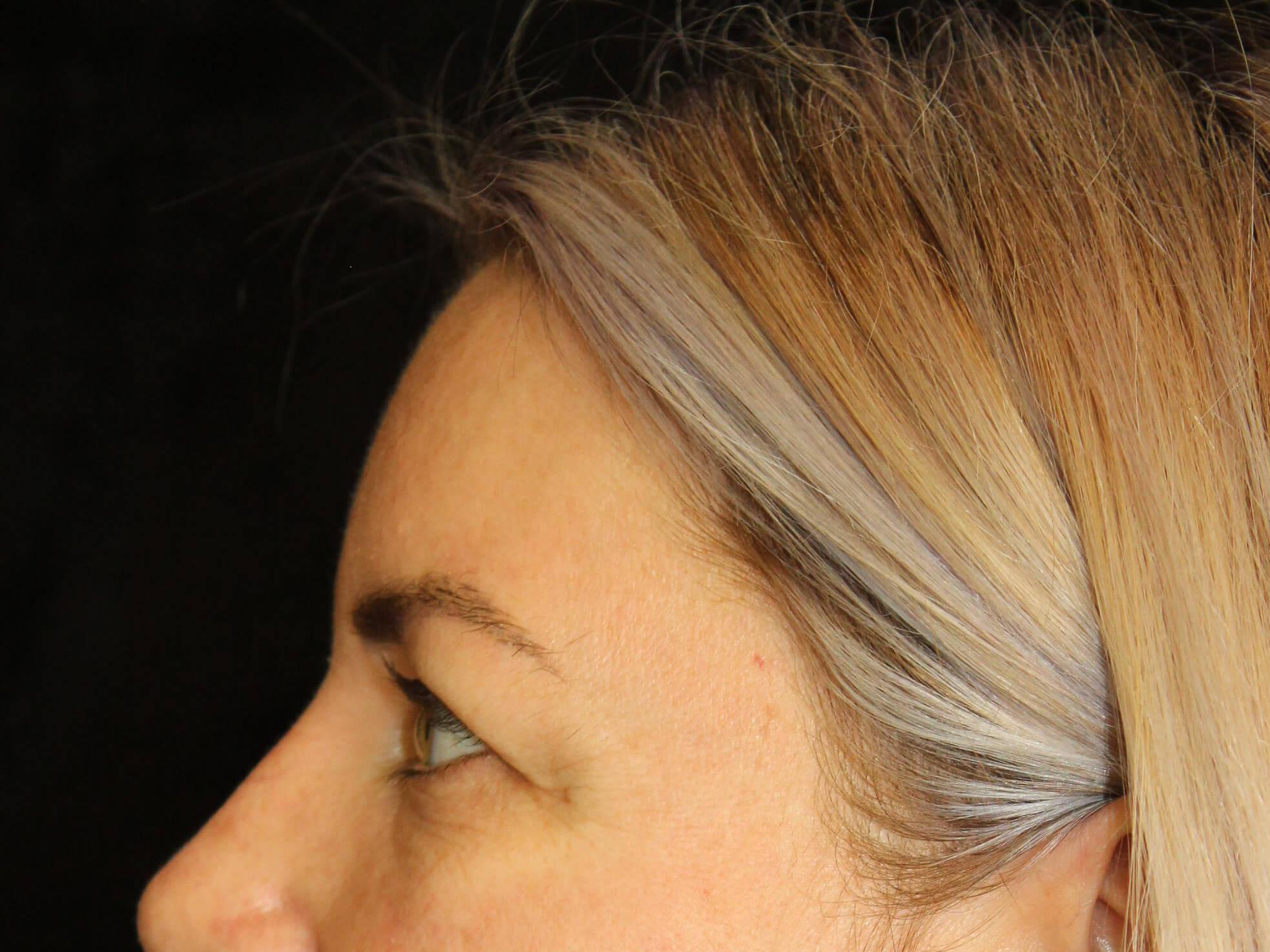 Eyelid Surgery Patient Photo - Case 18654 - before view-3