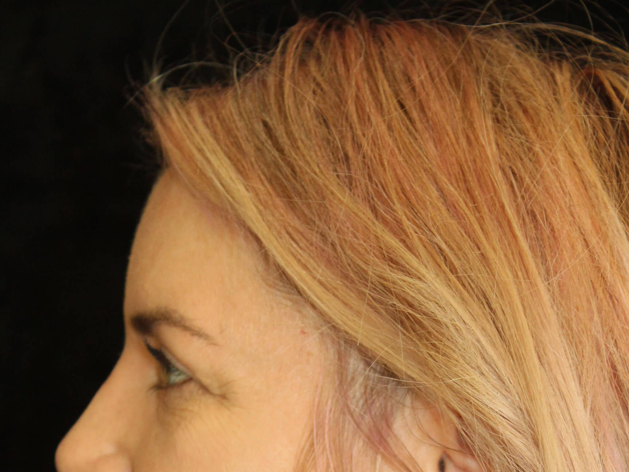 Eyelid Surgery Patient Photo - Case 18654 - after view-3