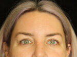 Eyelid Surgery - Case 18654 - Before