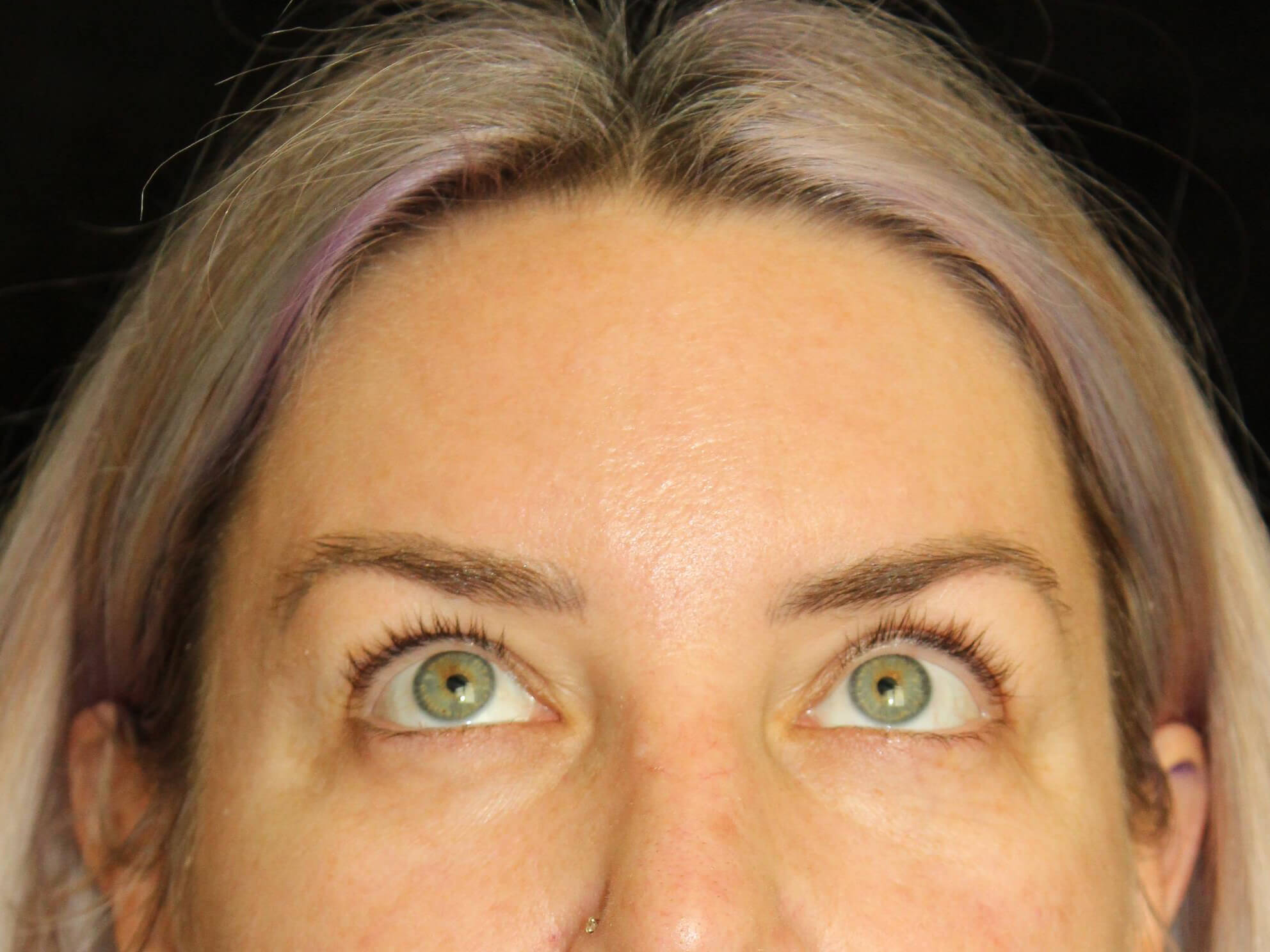 Eyelid Surgery Patient Photo - Case 18654 - before view-1