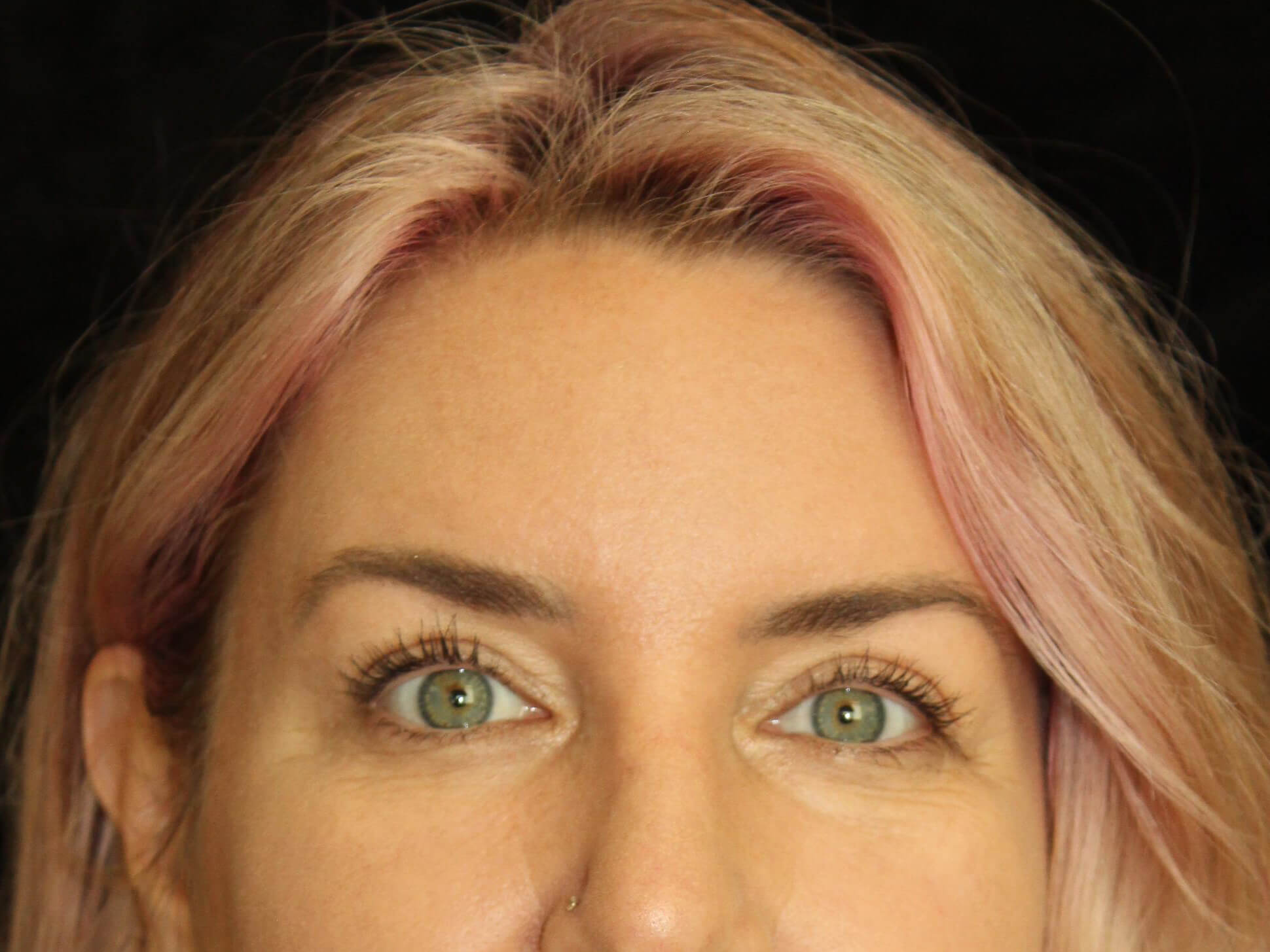 Eyelid Surgery Patient Photo - Case 18654 - after view